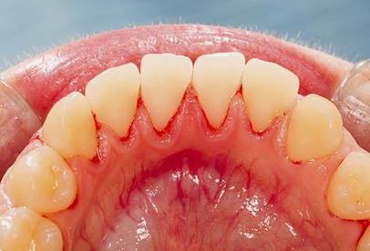 Gum Disease and Bad Breath Treatment in Brampton
