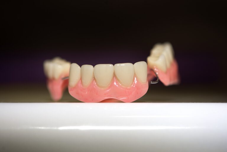 What Is a Dental Bridge