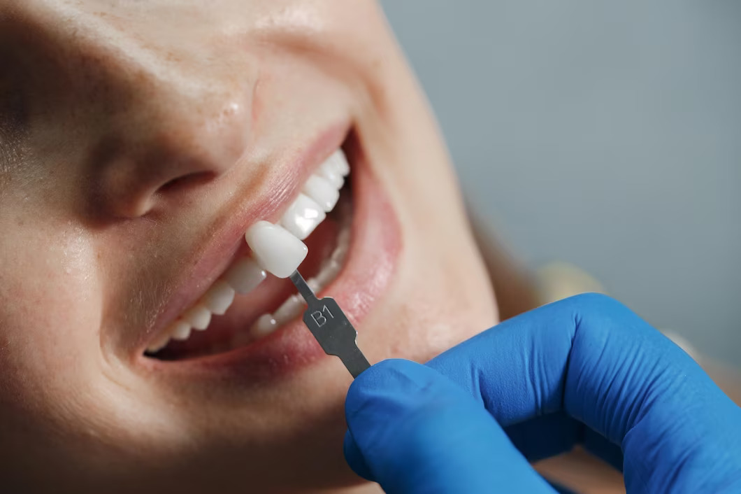 5 Surprising Benefits of Dental Crowns You Never Knew