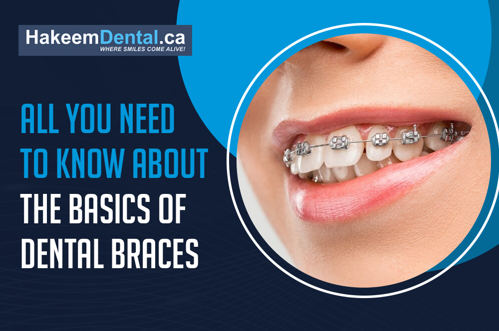 Basics of Dental Braces