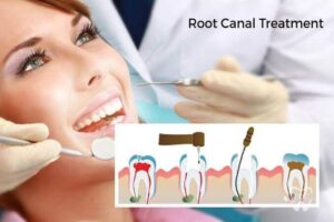 What To Expect From Root Canal Treatment