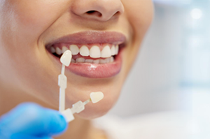 Dental Veneers: A Complete Guide to a Perfect Smile