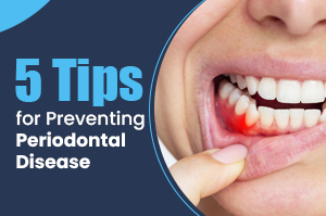 5 Tips for Preventing Periodontal Disease