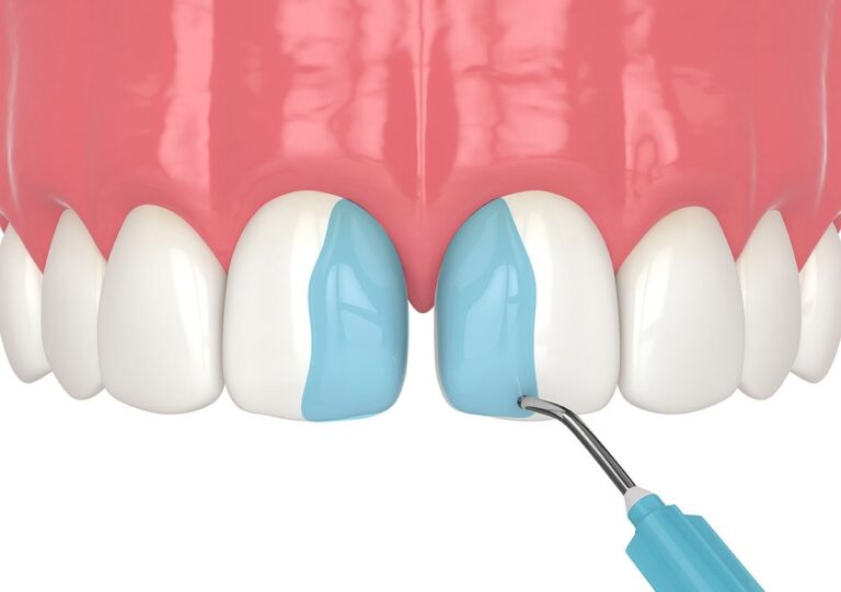 How Long Does Dental Bonding Last on Teeth