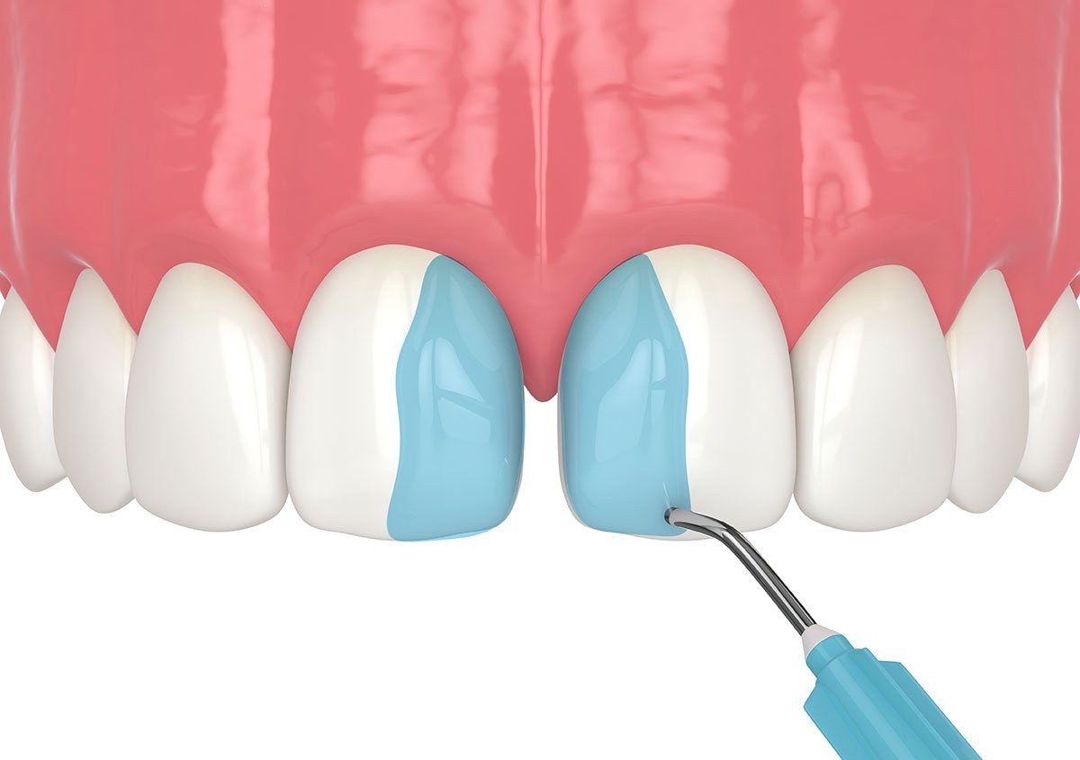 How Long Does Dental Bonding Last on Teeth