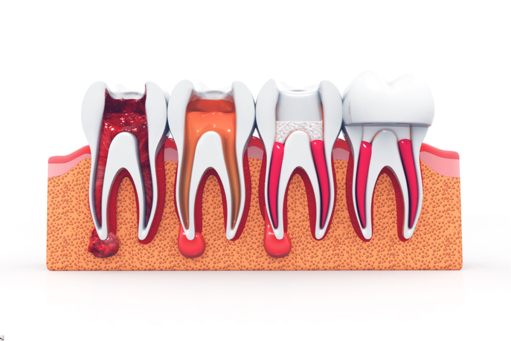 How Much Does A Root Canal Cost in Brampton