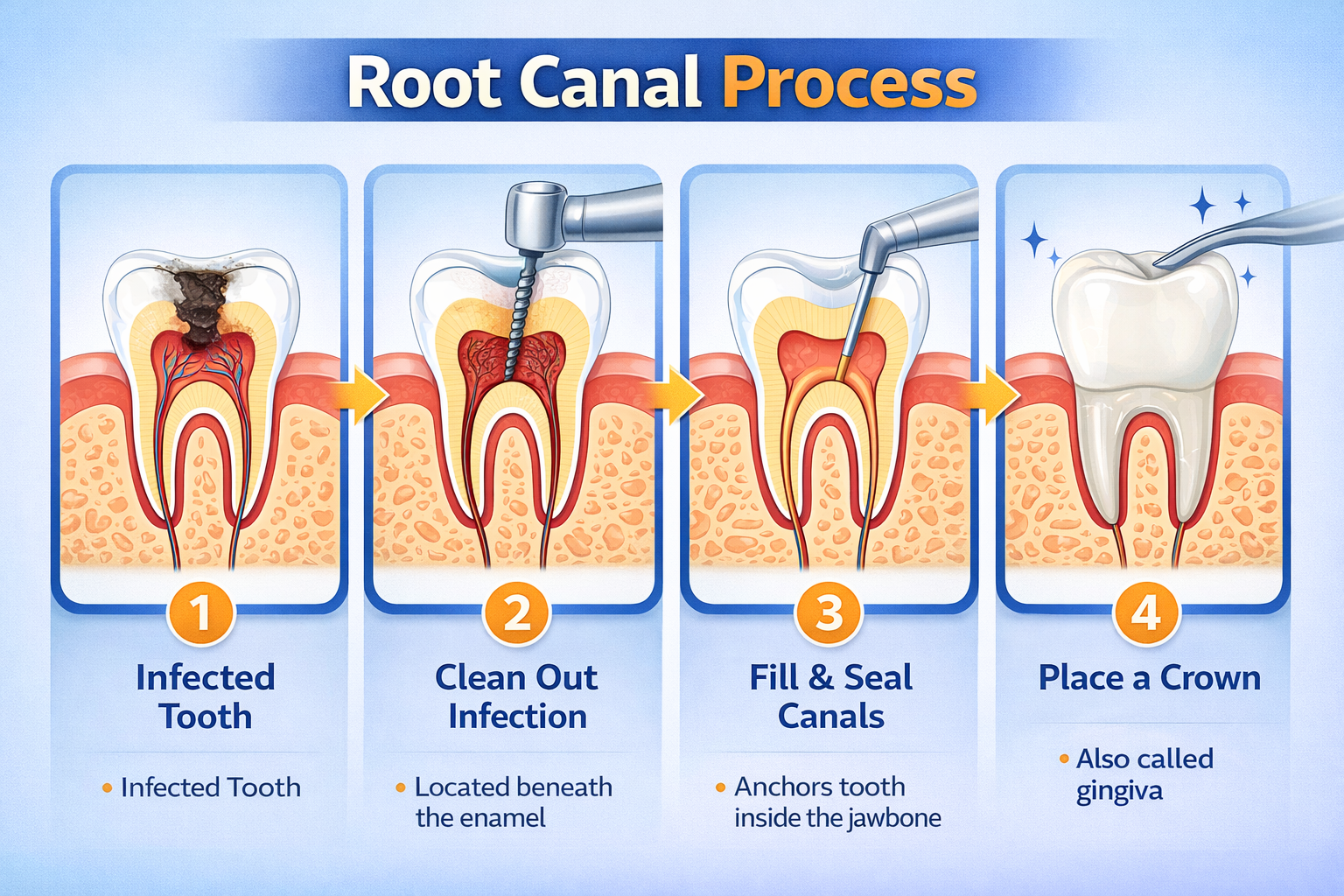 Root canal steps explained visually